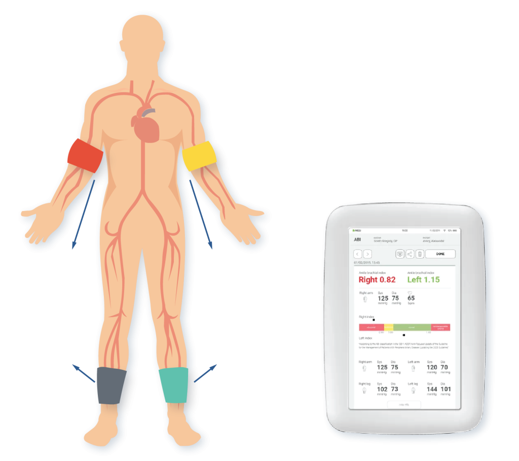 Ankle Brachial Index Abi Lifecare