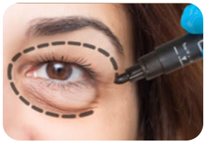 Non- Cosmetics Eyelid Surgery