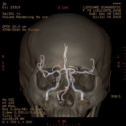 CT Scan-Brain