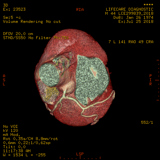 CT Scan-Coronary