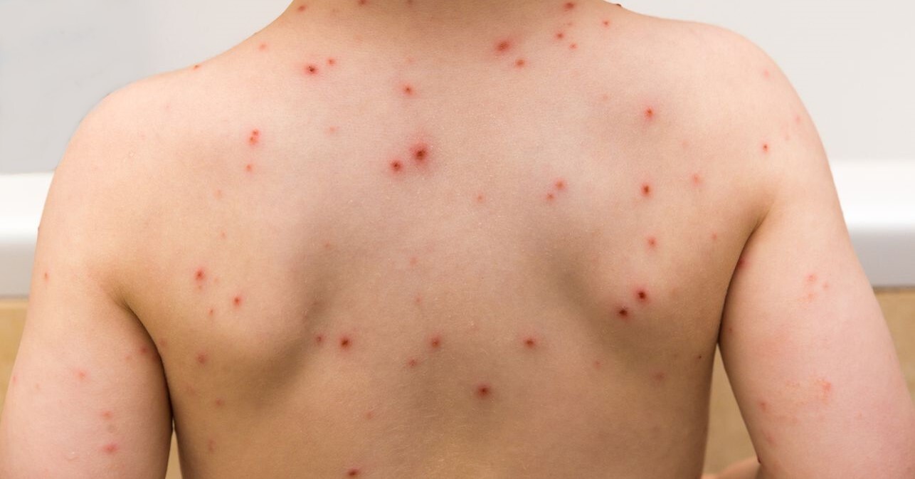 chicken-pox-1.jpg chicken-pox-1.jpg