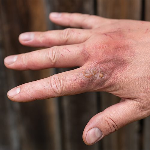 burn care
