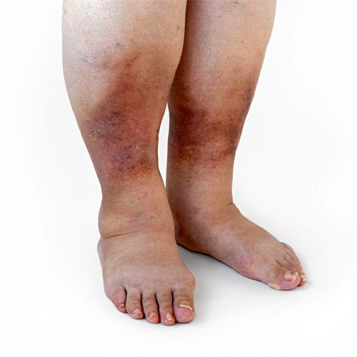 Gas gangrene