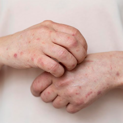 infection