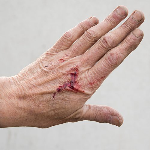 wound healing